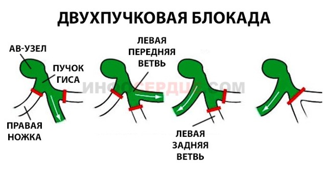 Неполная блокада левой ножки пучка Гиса - причины, лечение