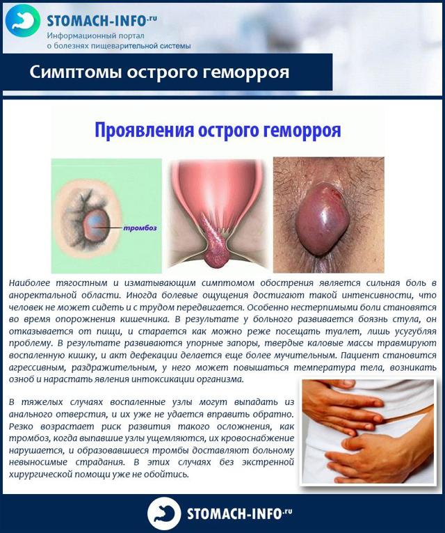Как обезболить геморрой в домашних условиях быстро