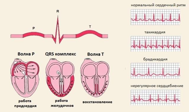Регулярный и нерегулярный синусовый ритм сердца