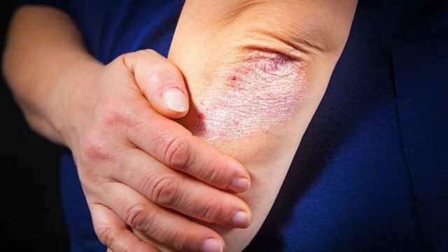ЦИНОКАП - инструкция по применению, цена, отзывы, аналоги