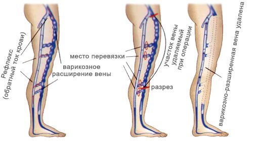 Что важно знать о флебэктомии — операции по удалению вен