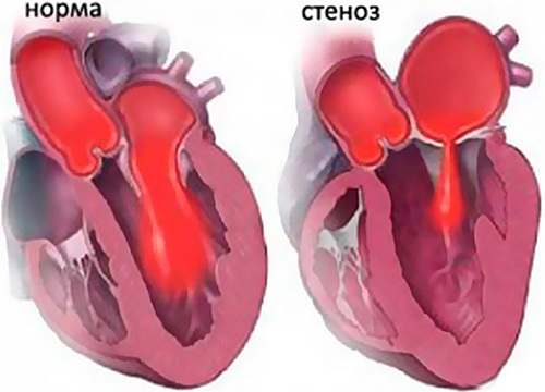 Анатомия сосудов легких. Легочная артерия