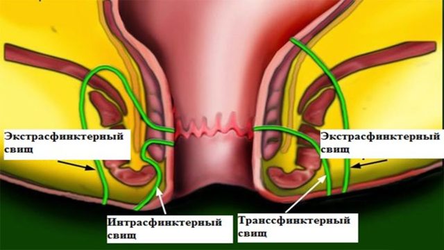 Узлы в прямой кишке - Геморроидальные узлы