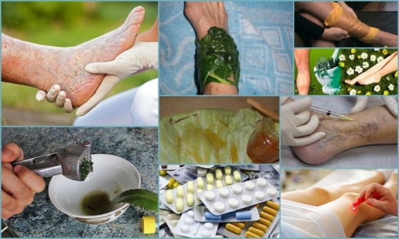 Народные средства от тромбофлебита нижних конечностей: травы, мед, лечение в домашних условиях