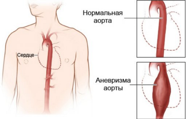 Боли в области сердца при различных заболеваниях - причины, характер, лечение