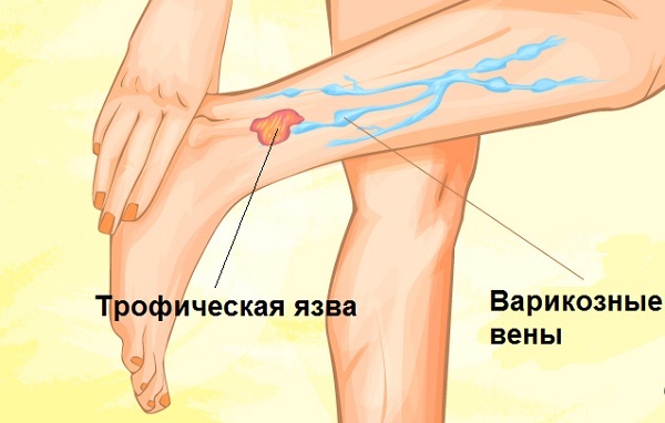 Трофические язвы нижних конечностей: виды, симптомы, лечение