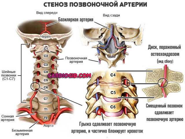 Синдром позвоночной артерии: симптомы, лечение, прогноз