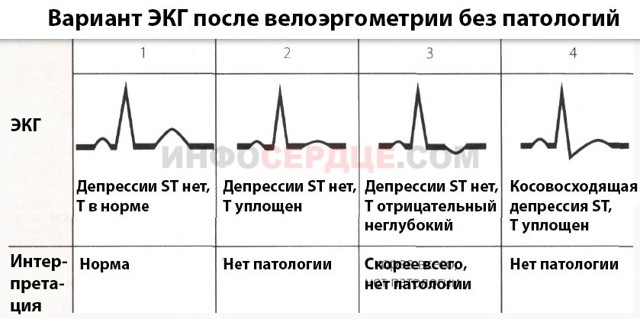 Велоэргометрия (ВЭМ). Проведение сердечного диагностического теста.