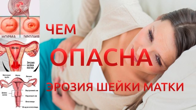 Эрозия шейки матки - что это?
