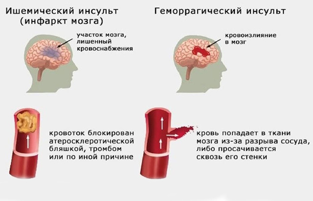Восстановление речи после инсульта в домашних условиях и у логопеда