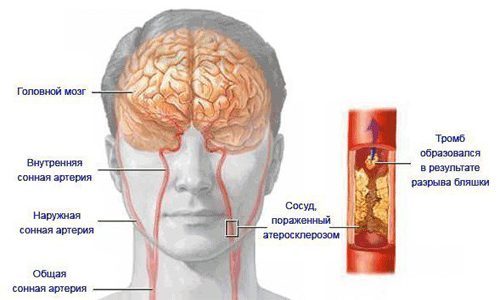 Какой врач лечит сосуды головного мозга, атеросклероз?