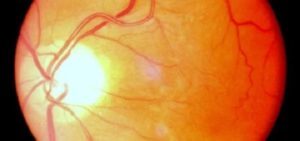 Сосуды глазного дна у ребенка расширены - Лечение гипертонии