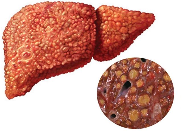 Повышенный билирубин – причины и симптомы билирубина, диагностика, лечение и профилактика