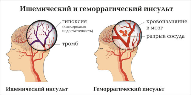 Сосуды головного мозга: симптомы, диагностика, лечение