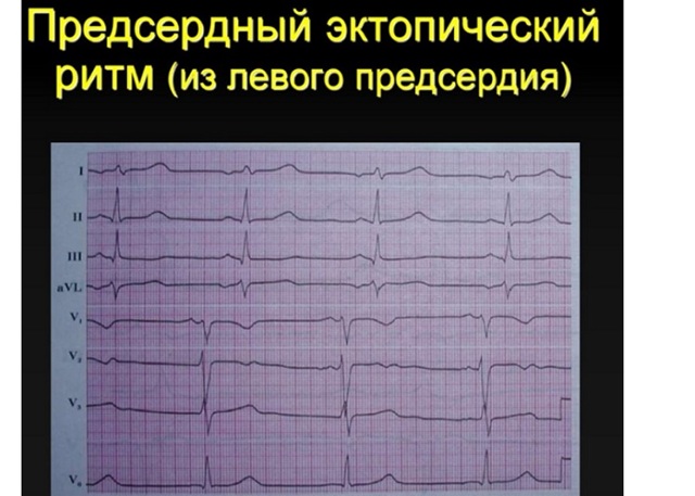 Предсердный ритм норма или патология?