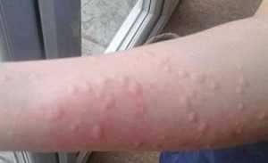 Симптомы и лечение аллергии на холод