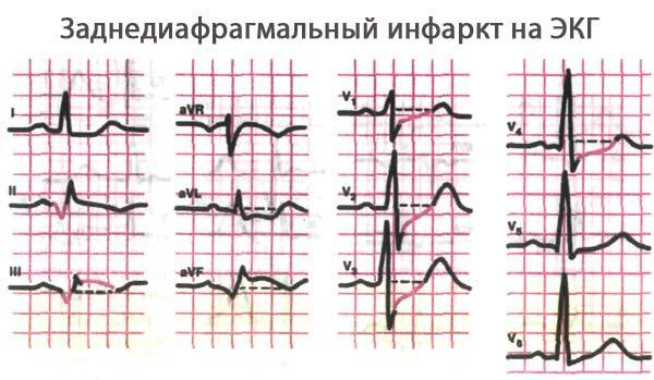 Инфаркт миокарда на ЭКГ: признаки, расшифровка
