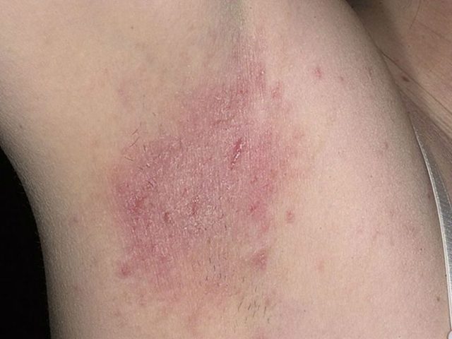 Атопический дерматит: фото, симптомы и лечение