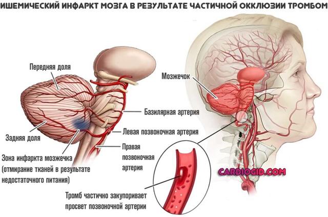 Инфаркт головного мозга - Мое Здоровье