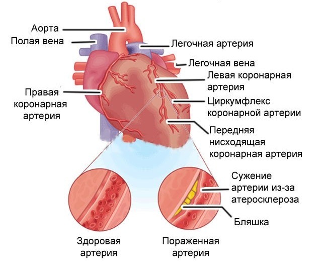 Самопомощь и неотложная помощь при стенокардии