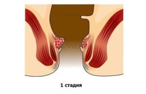 Геморрой при беременности - признаки, симптомы, причины и лечение