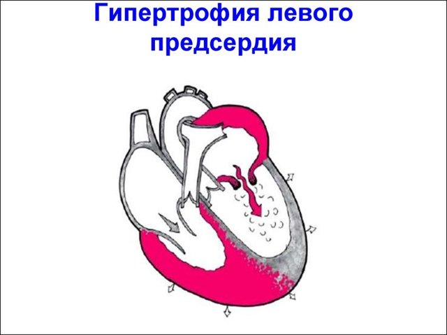 Утолщение стенок сердца - Все про гипертонию