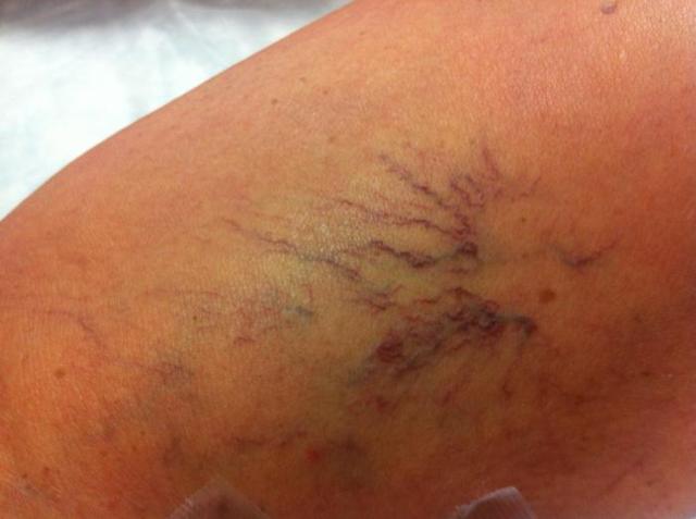 Болезни сосудов ног, лечение сосудов нижних конечностей