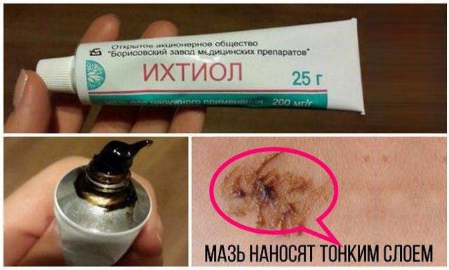 Ихтиоловые свечи - инструкция по применению