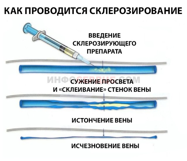 Кдо что это такое | Все о ретикулярном варикозе