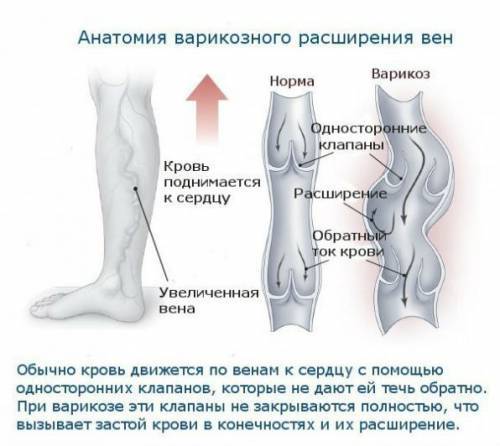 Болезни сосудов ног: причины появления и методы лечения