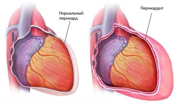 Сколько инфарктов может перенести человек - Боль в Сердце