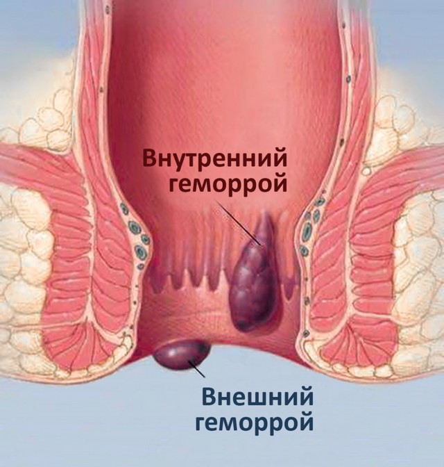 Гепариновая мазь при геморрое: как применять во время беременности
