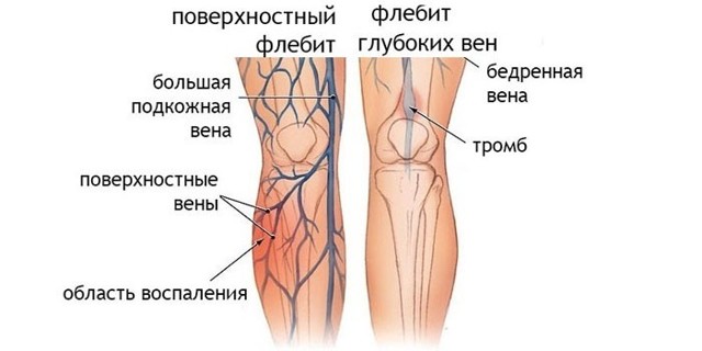 Флебит - что это такое, причины, симптомы, лечение