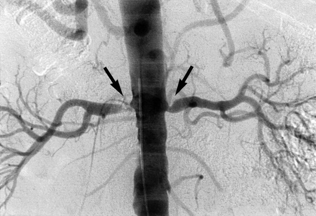 Реноваскулярная гипертензия - лечение, причины