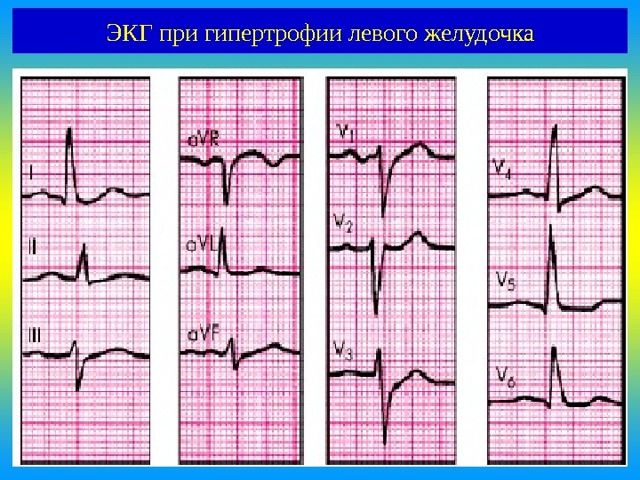Гипертрофия левого желудочка сердца: признаки на ЭКГ и лечение