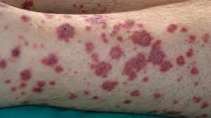 Васкулит на ногах - что это такое и как лечить?