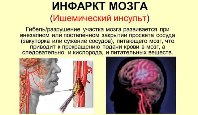 Ишемический инсульт головного мозга: прогноз для жизни у пожилых людей