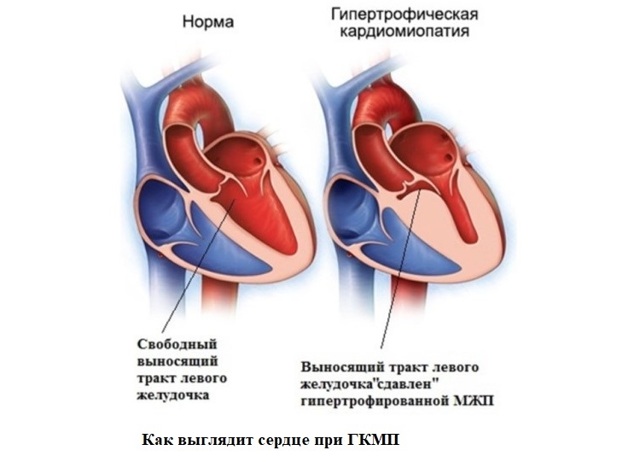 Гипертрофическая кардиомиопатия.