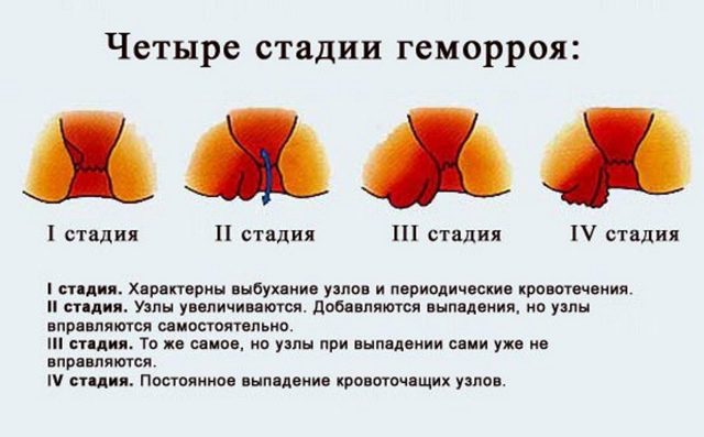 Что делать если геморрой не вправляется — Сайт о геморрое