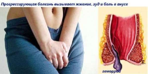 Чешется ли геморрой - Геморрой