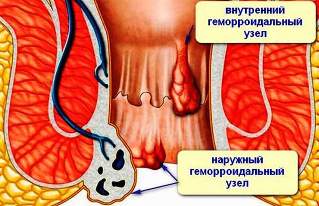 Свечи Бетиол – инструкция по применению, показания и противопоказания