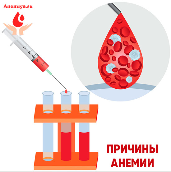 Анемия - что это такое и чем опасна, симптомы и лечение анемии, что кушать и как лечить