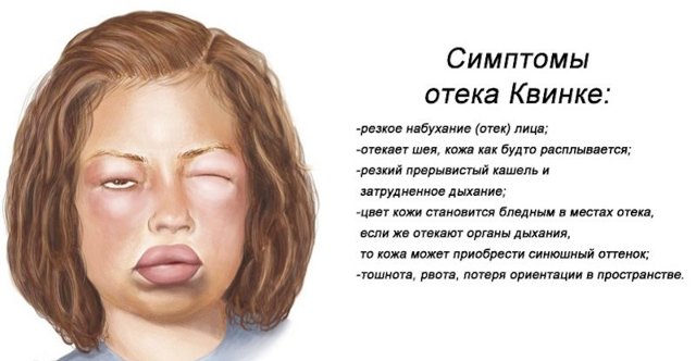 Крапивница фото симптомы и лечение у взрослых: список препаратов