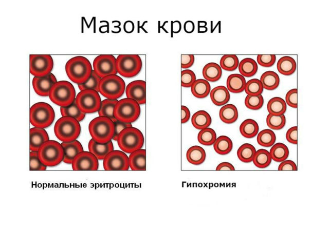 Гипохромия в общем анализе крови – что это такое?
