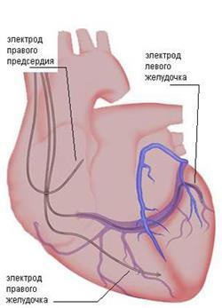 Функциональные классы ХСН