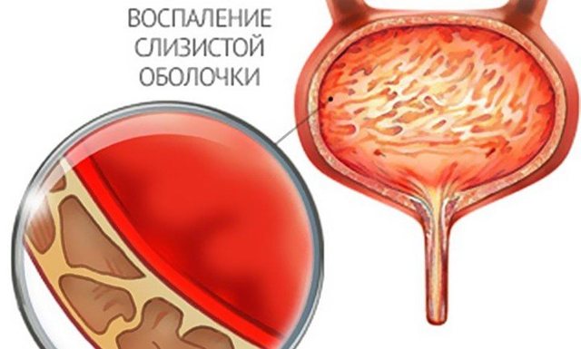 Как лечить зуд и жжение в интимной зоне у женщин
