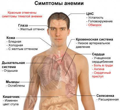 Анемия - формы, лечение, причины, симптомы, диагностика