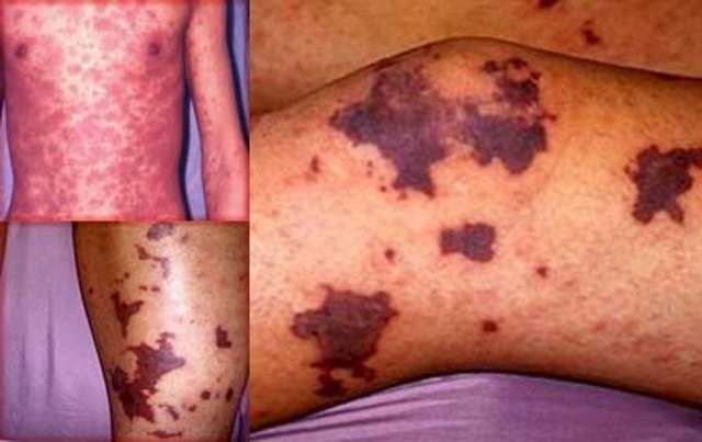 Идиопатическая тромбоцитопеническая пурпура.