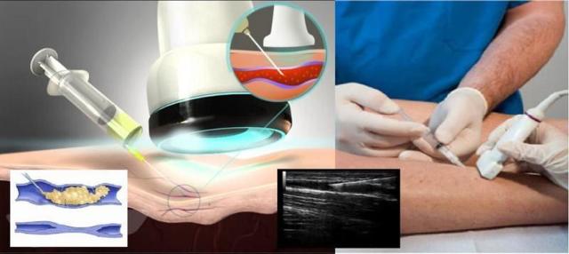 Осложнения и последствия после склеротерапии