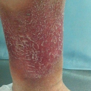 Варикозный дерматит нижних конечностей лечение народными средствами на сайте варикоз